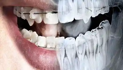رادیولوژی دندان (OPG)