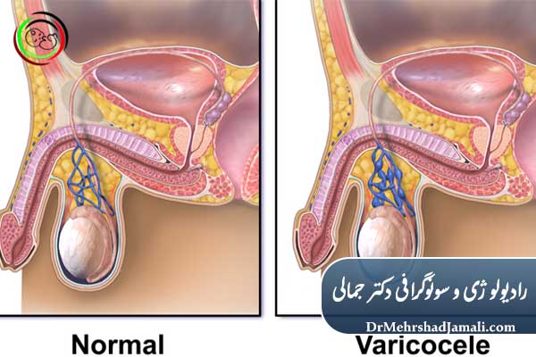 گرید های واریکوسل
