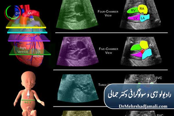 چه کسانی حتماً باید اکو قلب جنین انجام دهند؟