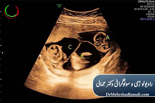 سونوگرافی چند قلویی