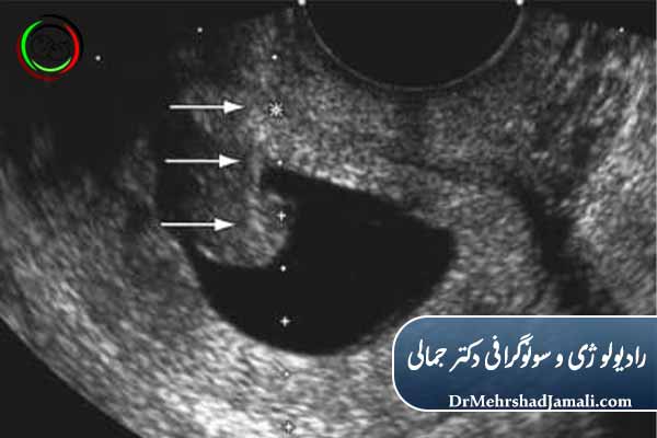 نحوه انجام تزریق KCL