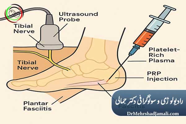 کاربردهای تزریق PRP با هدایت سونوگرافی