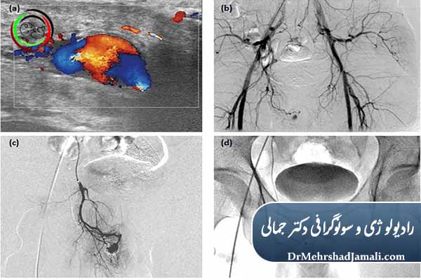  آمبولیزاسیون پنیس بهتر است یا جراحی؟