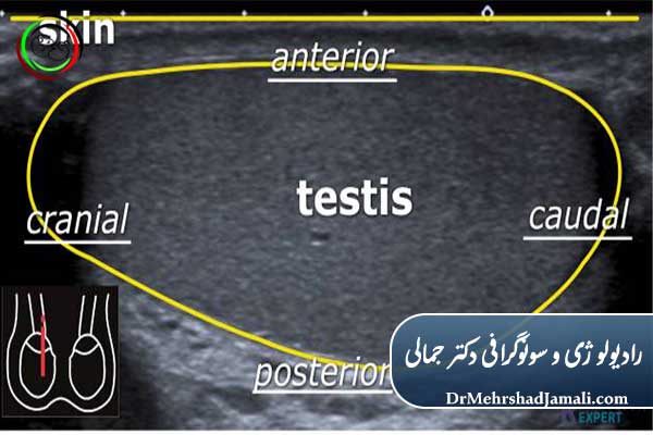 کاربرد سونوگرافی بیضه