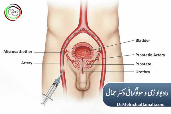  مراحل انجام آمبولیزاسیون پنیس چگونه است؟