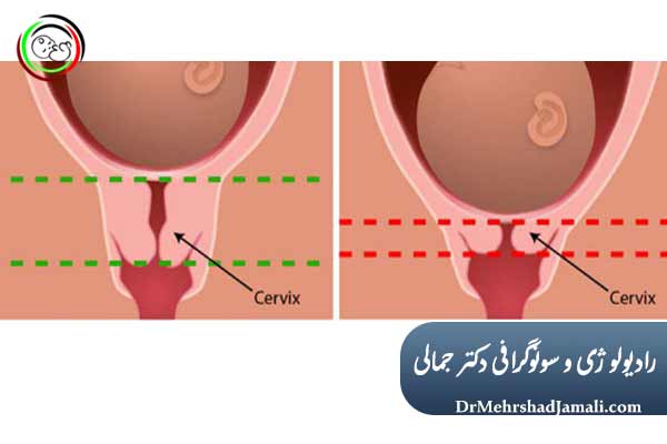 اهمیت سونوگرافی طول سرویکس