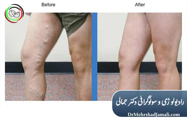سونوگرافی تخصصی عروق و واریس (ورید)