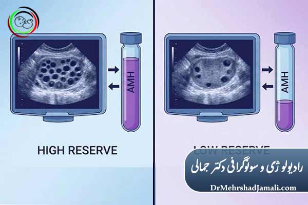 سونوگرافی شمارش فولیکول های آنترال