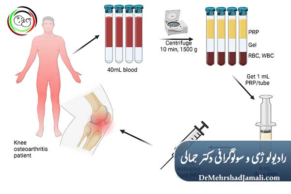 تزریق PRP یا پلاسمای غنی از پلاکت