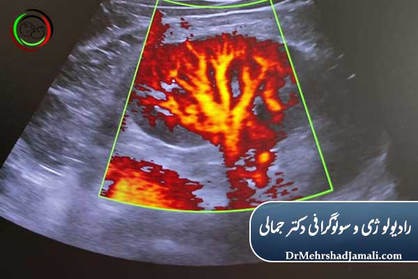 سونوگرافی داپلر