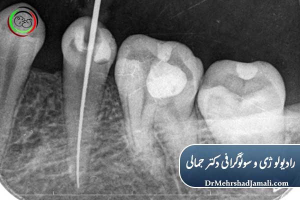 عکس پری‌آپیکال