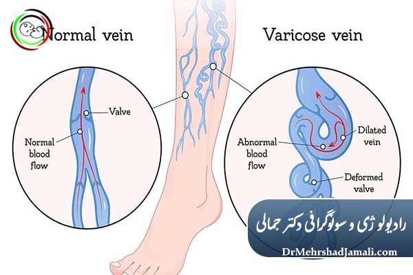 چه زمانی انجام سونوگرافی واریس ضروری