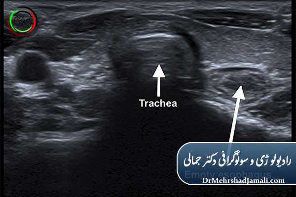 سونوگرافی تیروئید