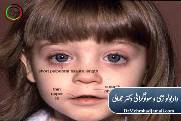 علائم و نشانه‌های سندرم الکل جنینی