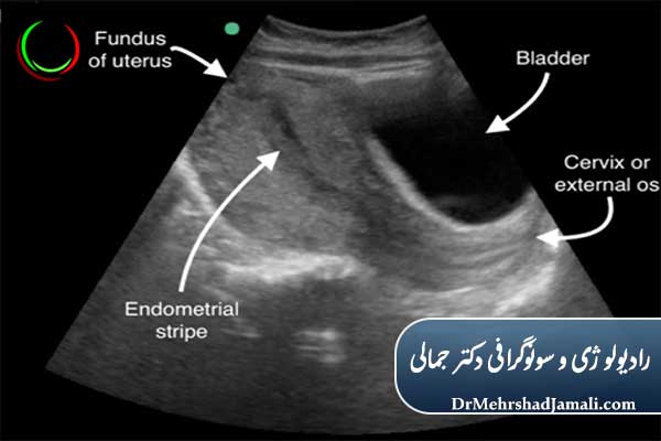 مراحل انجام سونوگرافی ترانس‌ابدومینال