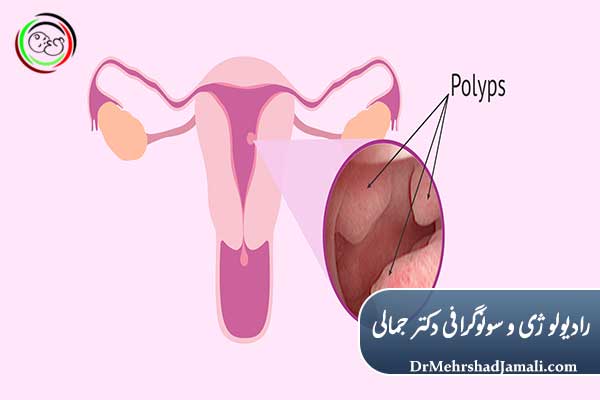 پولیپ رحم چیست؟