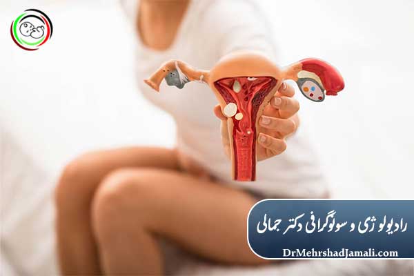 چرا علائم کیست تخمدان مهم هستند؟