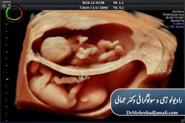 سونوگرافی چند قلوئی