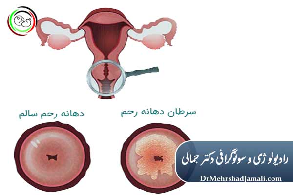 پیشگیری از سرطان دهانه رحم