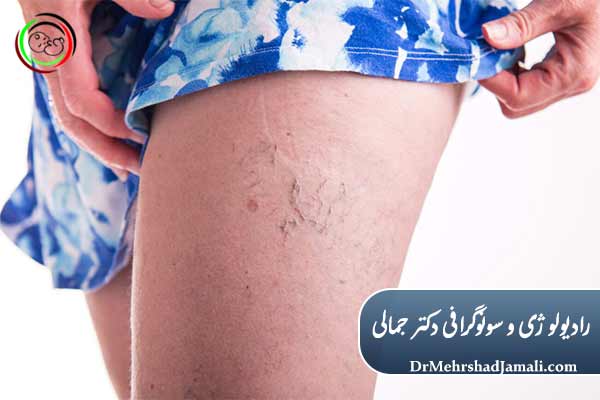 واریس چیست