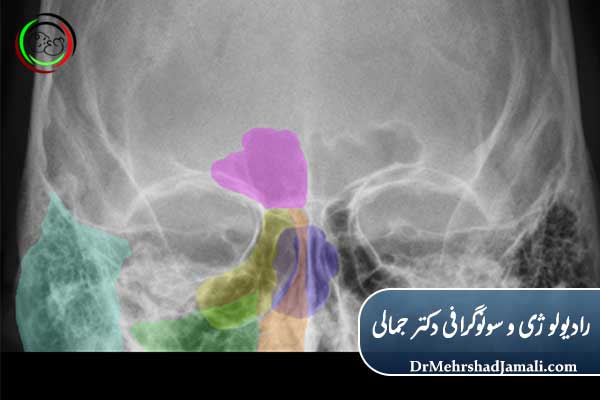 عکس سینوس‌ها