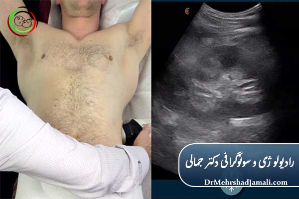 نحوه انجام سونوگرافی کلیه 