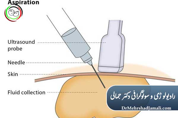کاربردهای تخلیه کیست