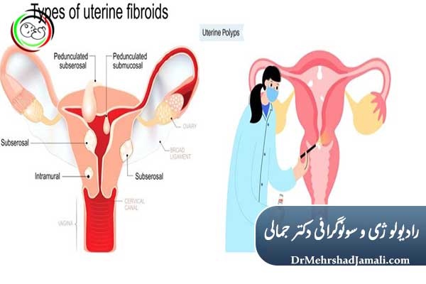 فیبروم رحم چیست؟