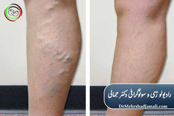 تشخیص واریس با سونوگرافی داپلر