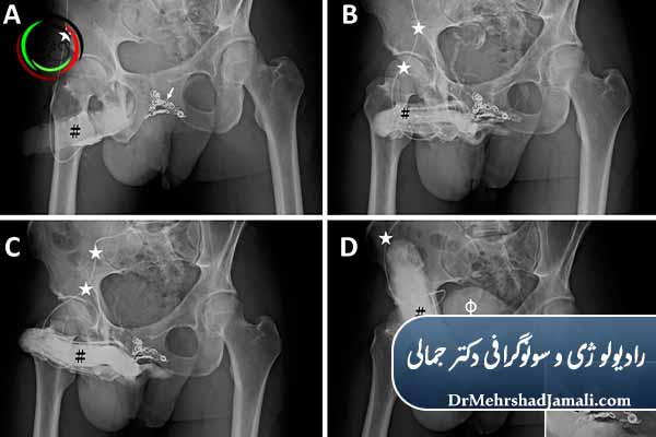  عوارض احتمالی آمبولیزاسیون پنیس