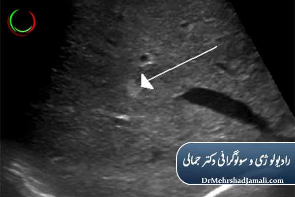 مراحل انجام اسکلروتراپی همانژیوم کبد