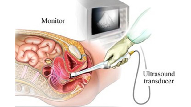 سونوگرافی رحم و لوله‌های فالوپ چگونه انجام می‌شود؟