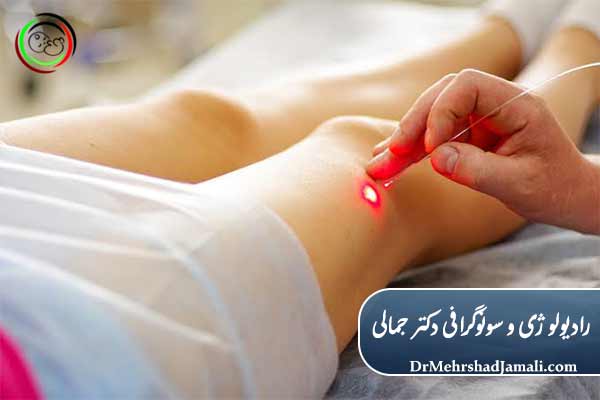 لیزر درون وریدی واریس