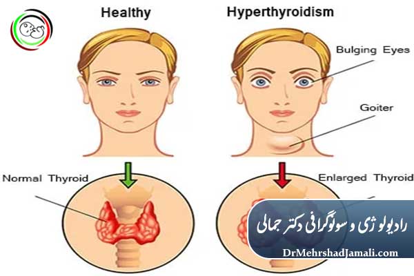 روشهای درمان پرکاری تیروئید