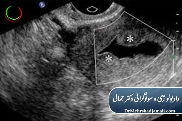 مزایای سونوهیستروگرافی