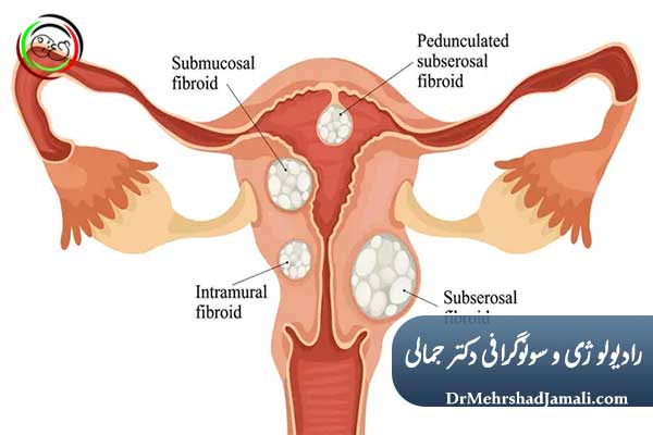 پولیپ و فیبروم در دوران بارداری