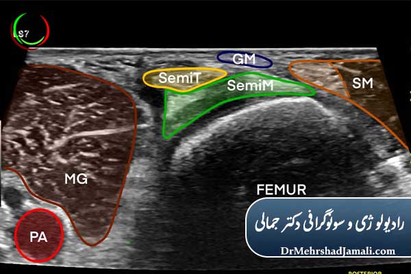تشخیص دقیق بیکر سیست 