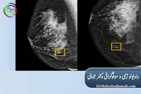 تفسیر یک گزارش ماموگرافی