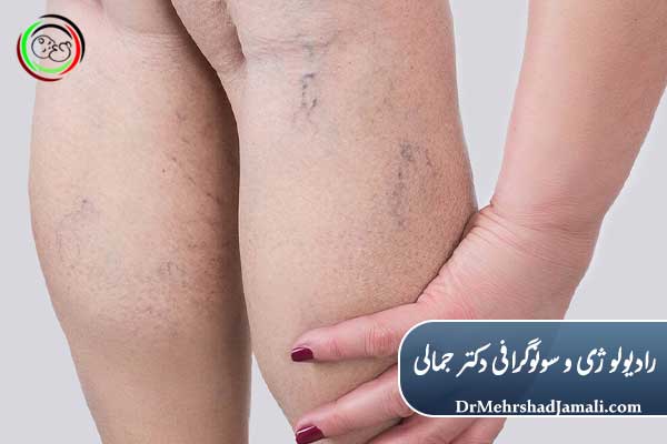 علت‌های ایجاد واریس بعد از بارداری