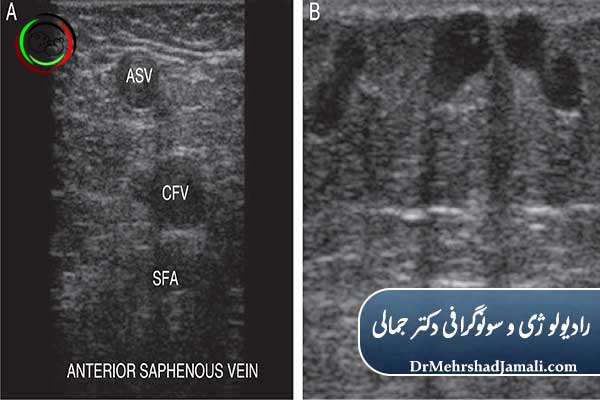مزایای سونوگرافی واریس (داپلر وریدی)