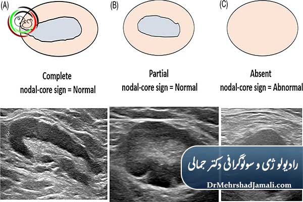 تفاوت غدد لنفاوی طبیعی و غیرطبیعی در سونوگرافی