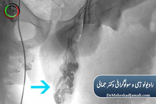 مزایای سونوگرافی واریکوسل