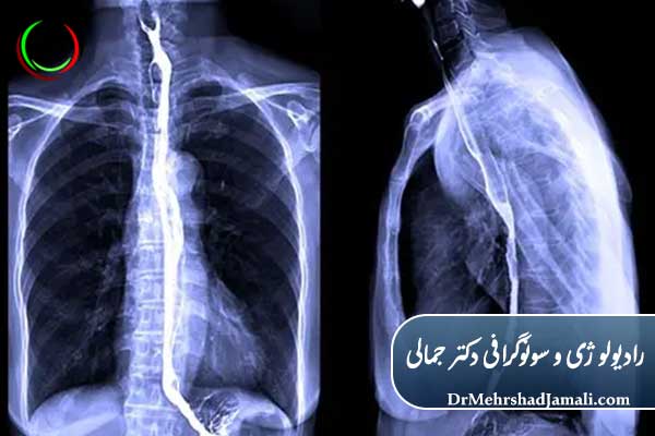 مزایای بلع باریم