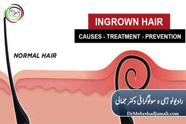 کیست مویی چیست؟