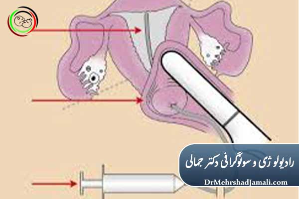 کاربردهای اصلی سونوگرافی با تزریق سالین
