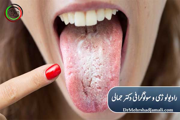 سفیدی زبان چیست ؟