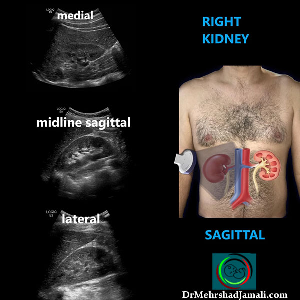 سونوگرافی کلیه و مثانه ، مجاری ادراری