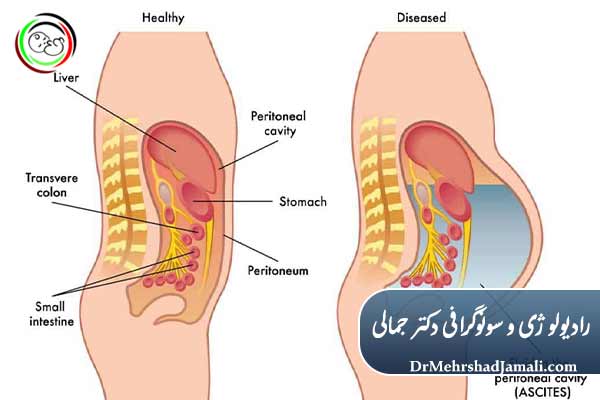 آیا تخلیه مایع شکمی عارضه دارد؟