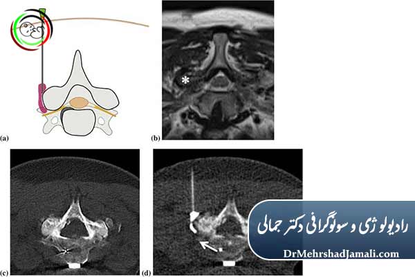 مزایای تزریقات با هدایت سیتی اسکن
