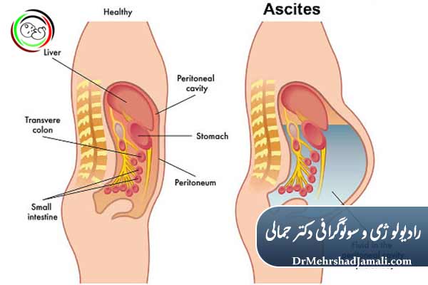 تخلیه آسیت با هدایت سونوگرافی